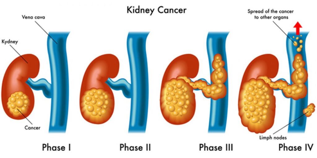 phases of kidney cancer